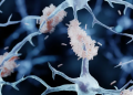 Alzheimer