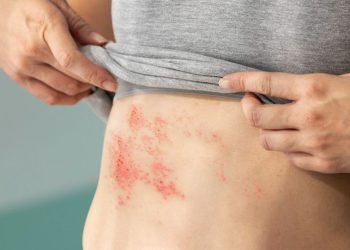 doença de chagas