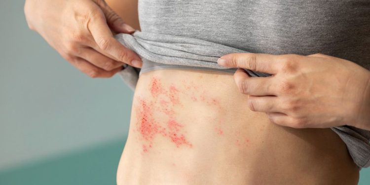 doença de chagas
