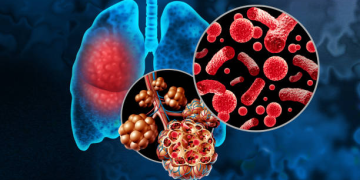 pneumonia