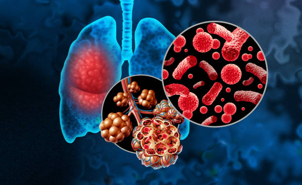 pneumonia