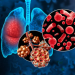 pneumonia