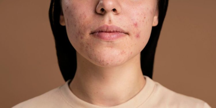 acne