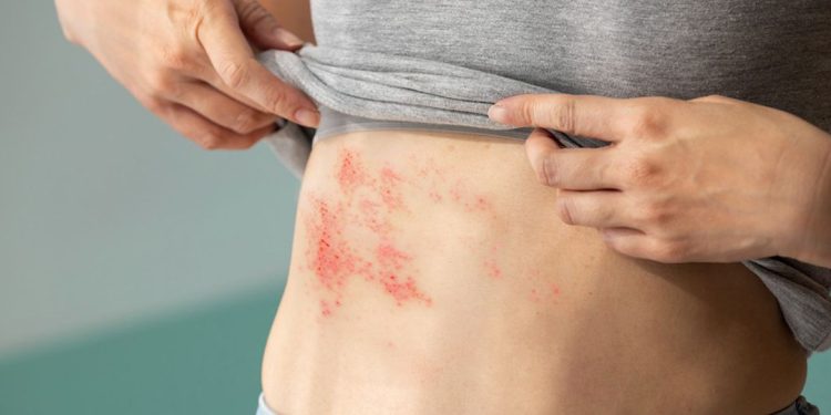 doença de chagas