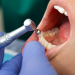dentes