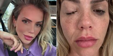 marcelly abreu bacteria olho