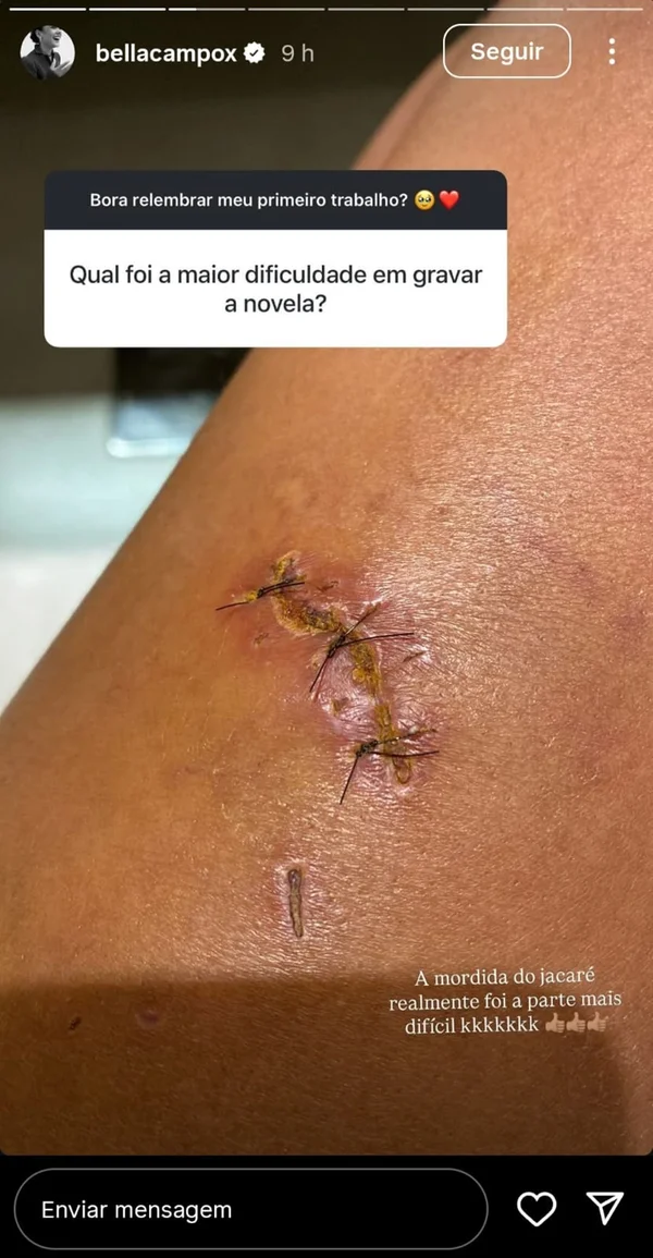 bella campos mordida jacaré