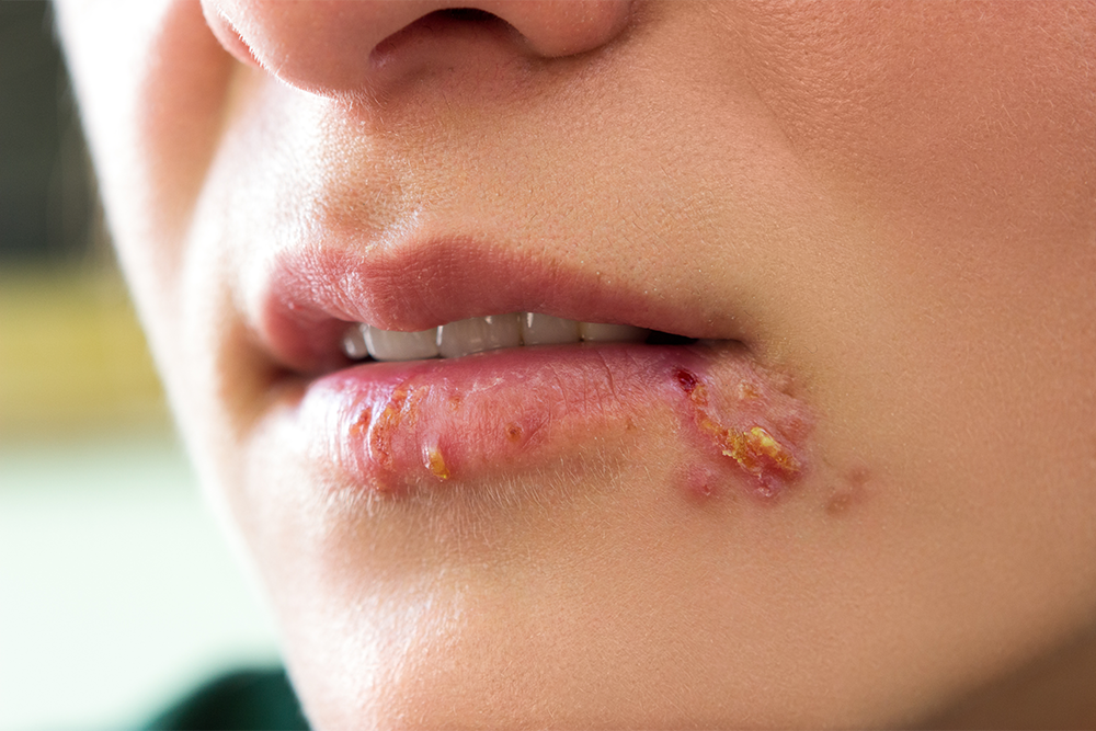vírus herpes doença