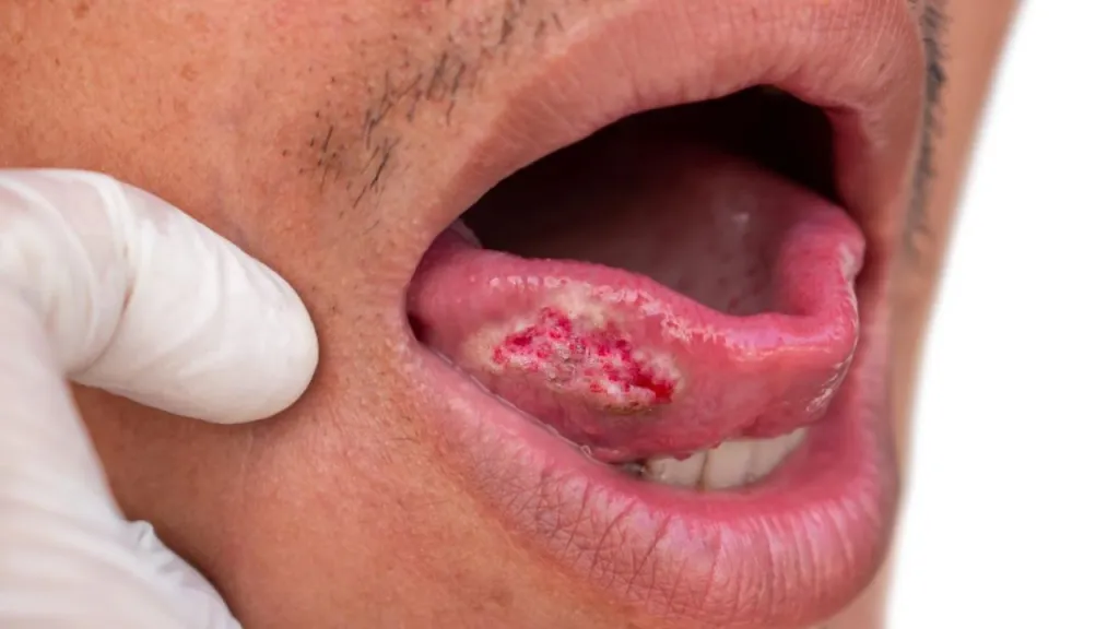 câncer de boca sintomas