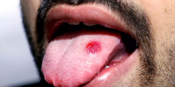 câncer de boca sintomas