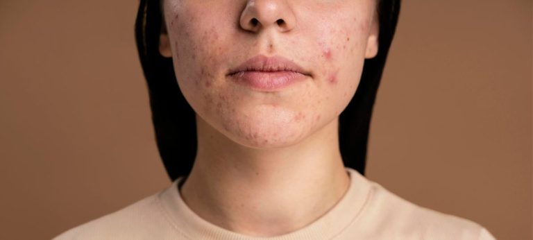 acne