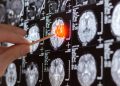 tumor cerebral IA