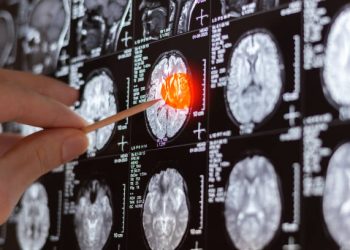 tumor cerebral IA