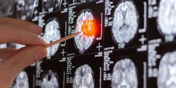tumor cerebral IA