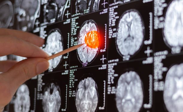 tumor cerebral IA