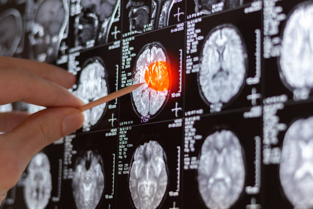 tumor cerebral IA