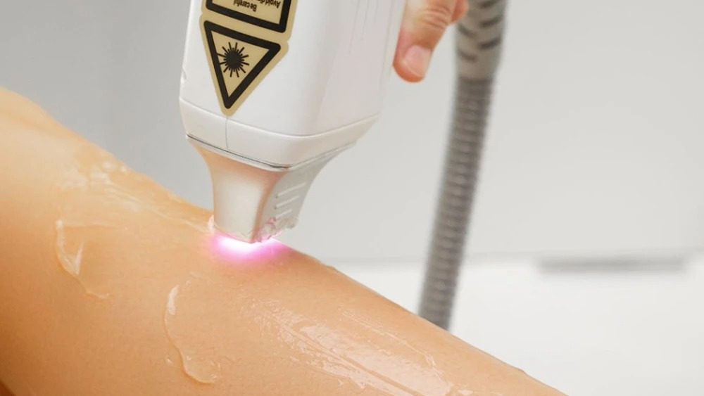 Clínica de depilação a laser de BH é condenada a indenizar cliente que teve as pernas queimadas 